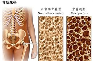 骨質(zhì)疏松 骨質(zhì)疏松