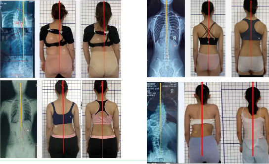 脊柱側(cè)彎治療 脊柱側(cè)彎治療