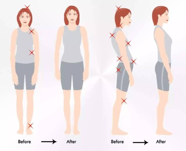 脊柱側(cè)凸預(yù)防 脊柱側(cè)凸預(yù)防